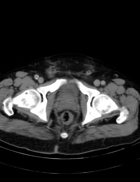 File:Abdominal lymphoma - with sandwich sign (Radiopaedia 53486-59492 Axial C+ portal venous phase 49).jpg