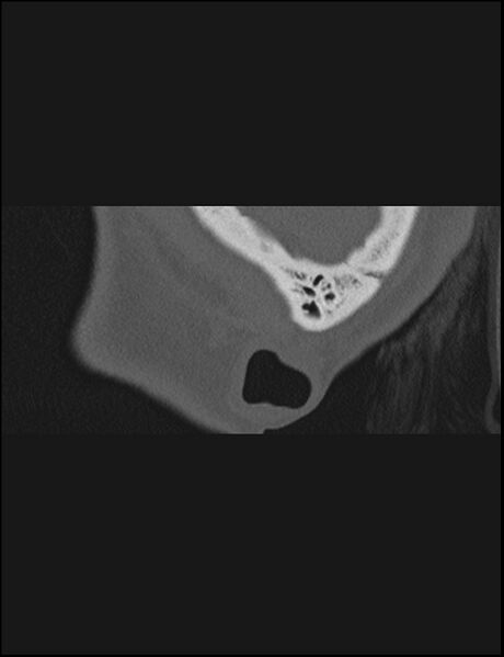 File:Aberrant right internal carotid artery (Radiopaedia 65191-74198 Sagittal non-contrast 7).jpg