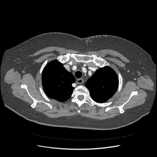 File:Aberrant right subclavian and left vertebral arteries (Radiopaedia 43467-46847 Axial C+ portal venous phase 22).jpg