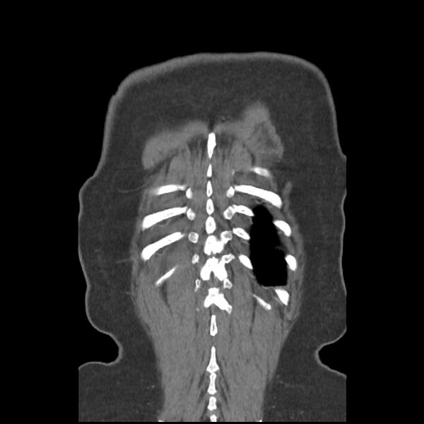 File:Aberrant right subclavian and left vertebral arteries (Radiopaedia 43467-46847 Coronal C+ portal venous phase 81).jpg