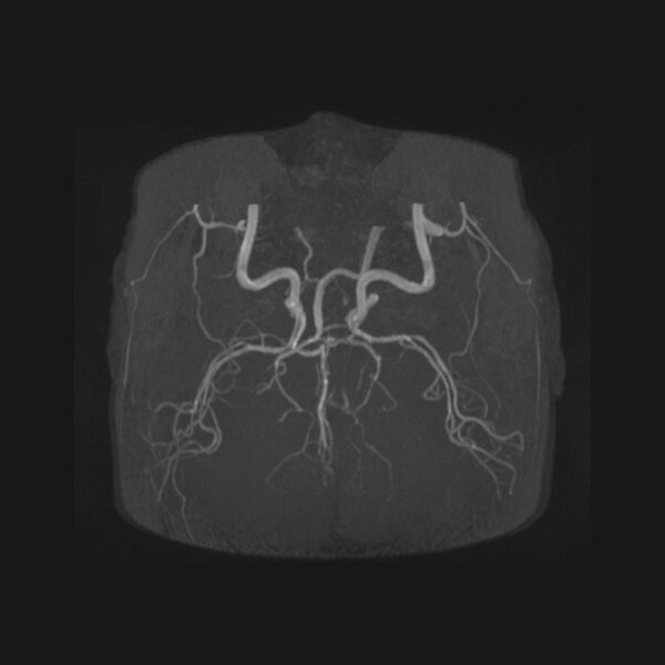 File:Accessory middle cerebral artery and ICA aneurysm (Radiopaedia 22656-22674 B 33).jpg