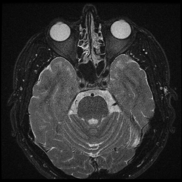 File:Acoustic schwannoma - intracanalicular (Radiopaedia 37247-39024 Axial T2 fat sat 11).jpg