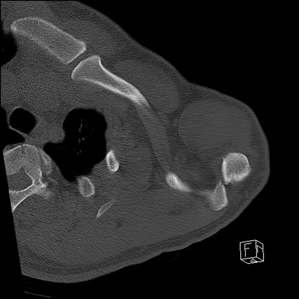 File:Acromioclavicular joint dissociation - type IV (Radiopaedia 64411-73216 Axial bone window 11).jpg