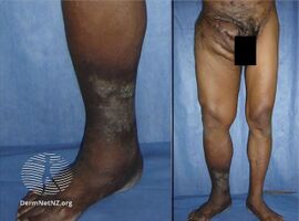 Actinomycetoma foot and legs