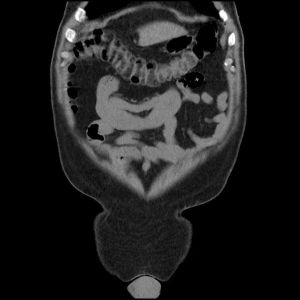 File:Active colonic bleed on CT (Radiopaedia 49765-55025 Coronal non-contrast 12).jpg