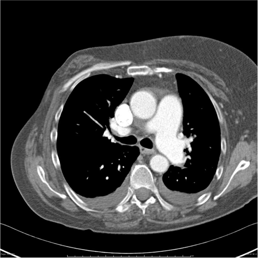 Acute-on-chronic pulmonary emboli (Radiopaedia 27925-28169 C+ CTPA 32).jpg