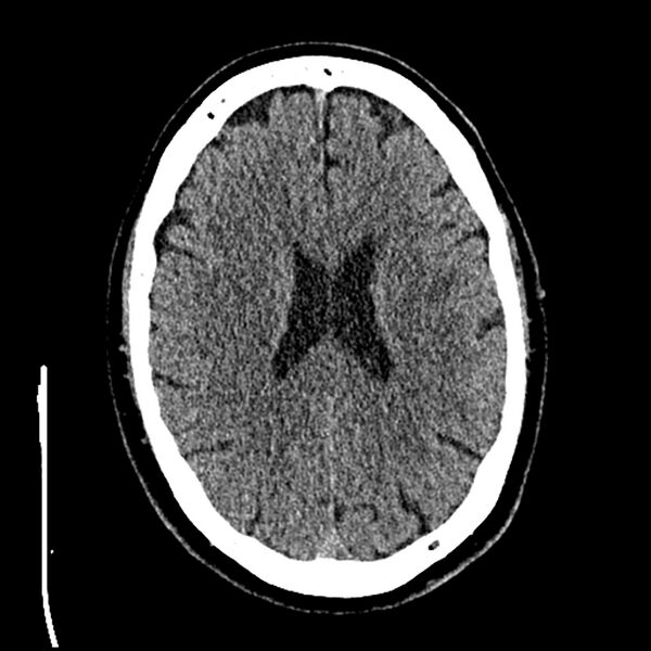 File:Acute A3 occlusion with ACA ischemic penumbra (CT perfusion) (Radiopaedia 72036-82525 Axial non-contrast thins 62).jpg