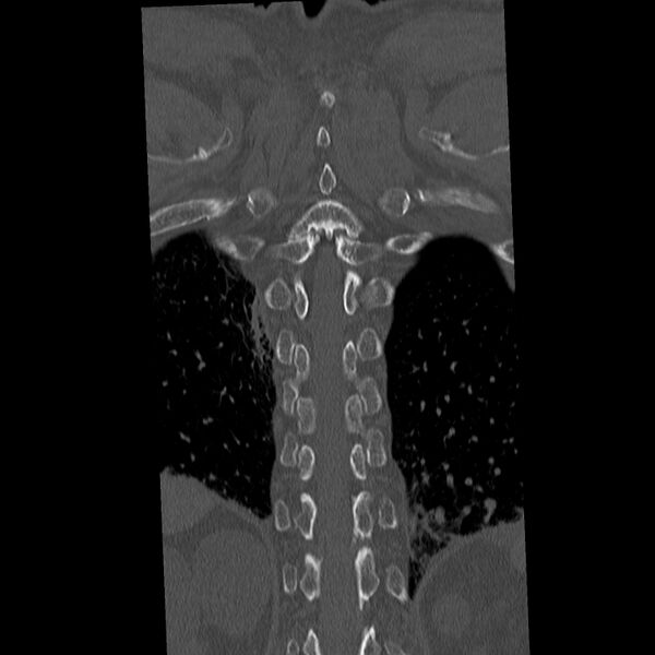 File:Acute and chronic vertebral compression fractures (Radiopaedia 31608-32494 Coronal bone window 36).jpg