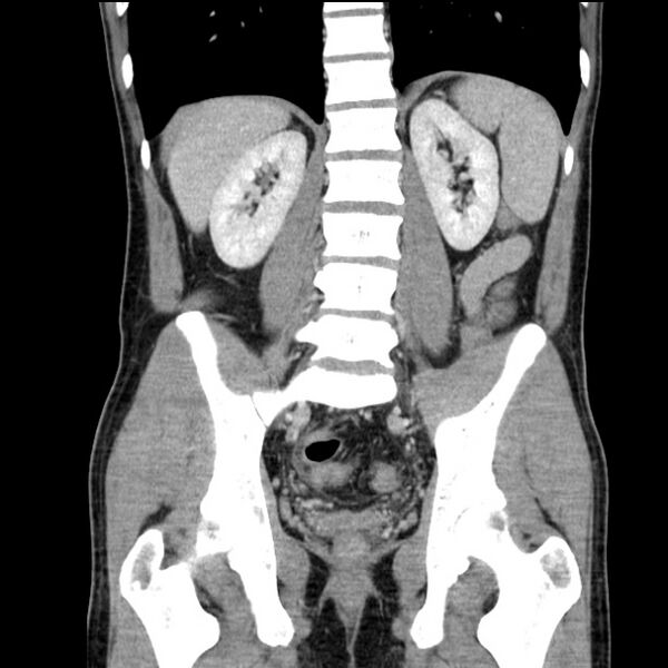File:Acute appendicitis (Radiopaedia 27049-27227 Coronal C+ portal venous phase 38).jpg