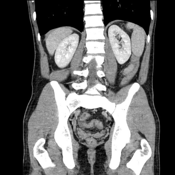 File:Acute appendicitis (Radiopaedia 27049-27227 Coronal C+ portal venous phase 40).jpg
