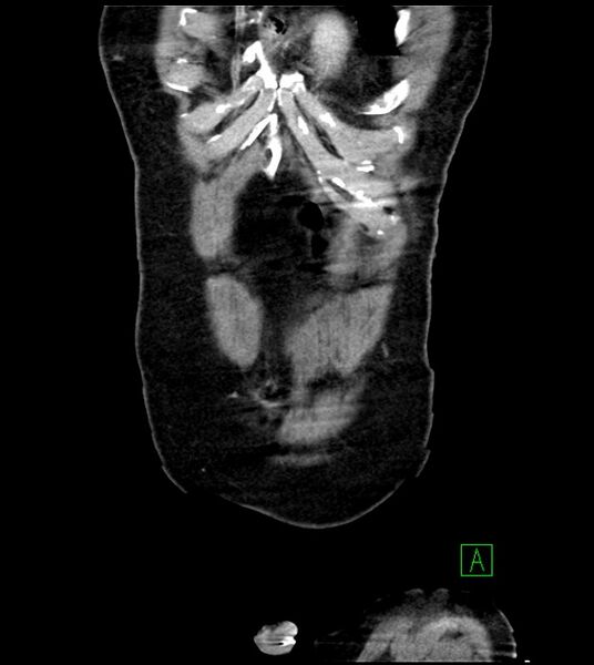 File:Acute arterial mesenteric ischemia (Radiopaedia 78238-90828 Coronal C+ portal venous phase 17).jpg