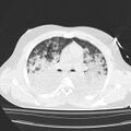 Acute aspiration pneumonitis (Radiopaedia 33605-34703 Axial lung window 43).jpg