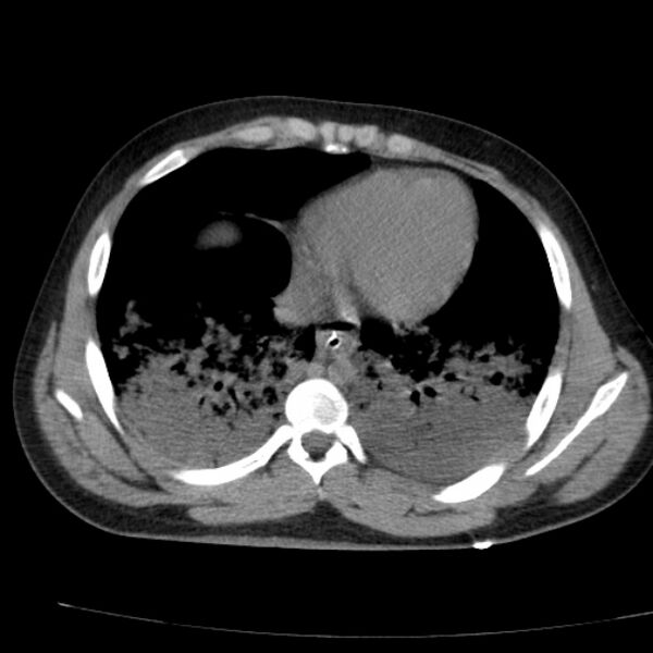 File:Acute aspiration pneumonitis (Radiopaedia 33605-34703 Axial non-contrast 60).jpg
