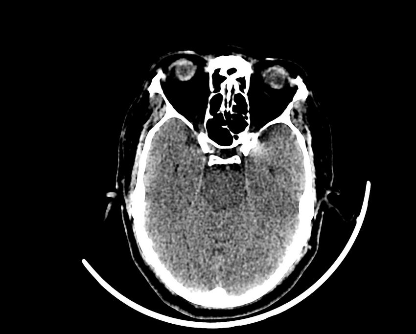 Acute cerebral infarct (Radiopaedia 35604-37123 Axial non-contrast 34).jpg