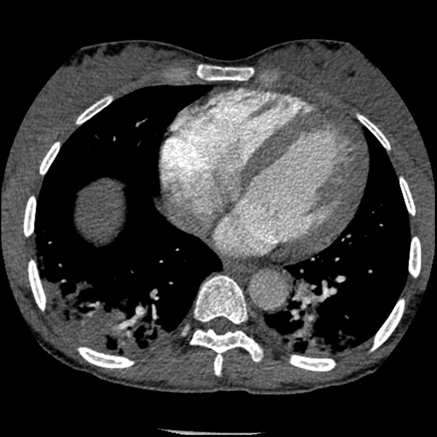 Acute chest syndrome - sickle cell disease (Radiopaedia 42375-45499 Axial C+ CTPA 132).jpg