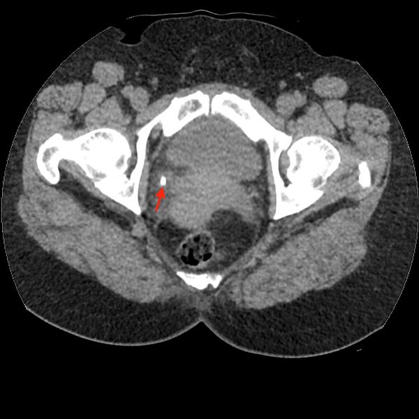 File:Acute cholecystitis and ureteric colic (Radiopaedia 42330-45446 Figure 2 1).jpg