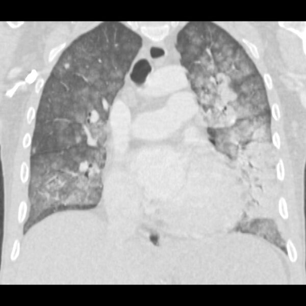 File:Acute diffuse alveolar hemorrhage (Radiopaedia 41323-44158 Coronal lung window 24).jpg