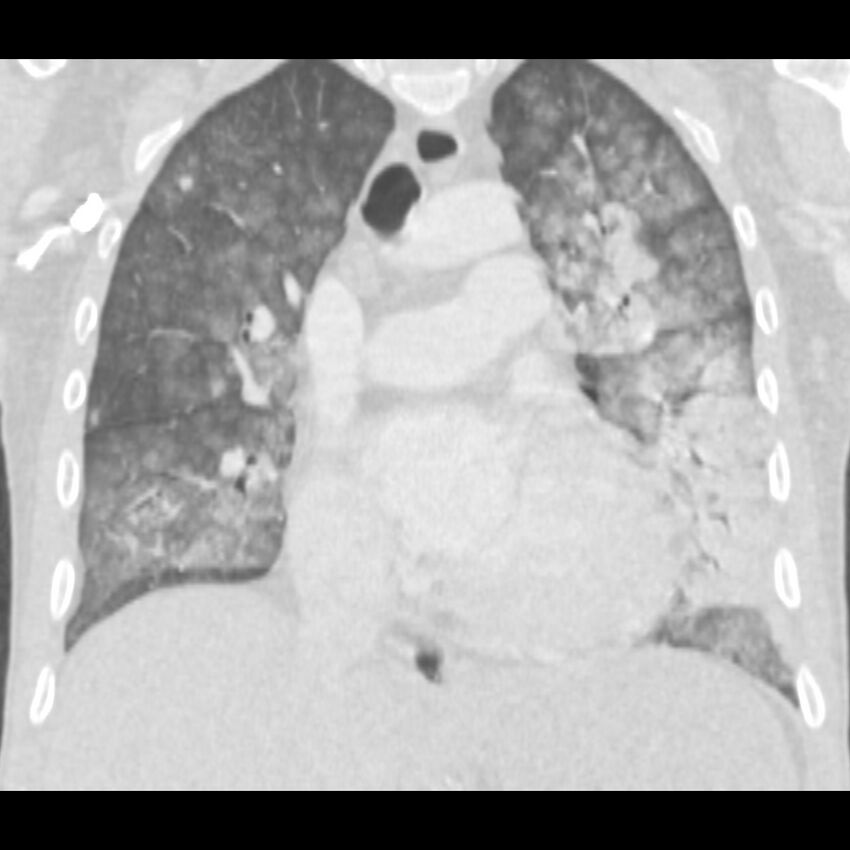 Acute diffuse alveolar hemorrhage (Radiopaedia 41323-44158 Coronal lung window 24).jpg