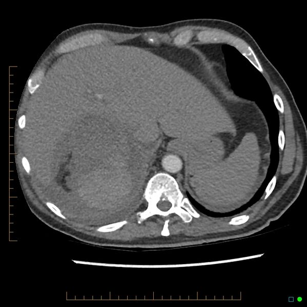 File:Acute hemorrhage into adrenal metastasis from NSCLC (Radiopaedia 43135-46429 Axial C+ CTPA 8).jpg
