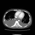 Acute myocarditis (Radiopaedia 55988-62613 Axial C+ portal venous phase 1).jpg