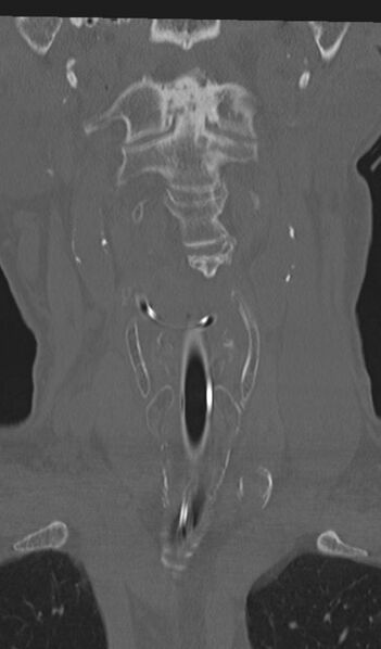 File:Acute on chronic subdural hematoma and thoracic vertebral injury in a multitrauma patient (Radiopaedia 31698-32619 Coronal bone window 11).jpg