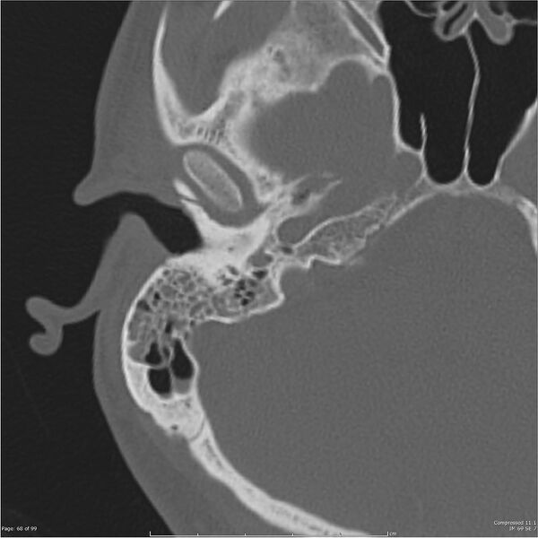 File:Acute otomastoiditis (Radiopaedia 28276-28512 Axial PTB bone window reformat 48).jpg
