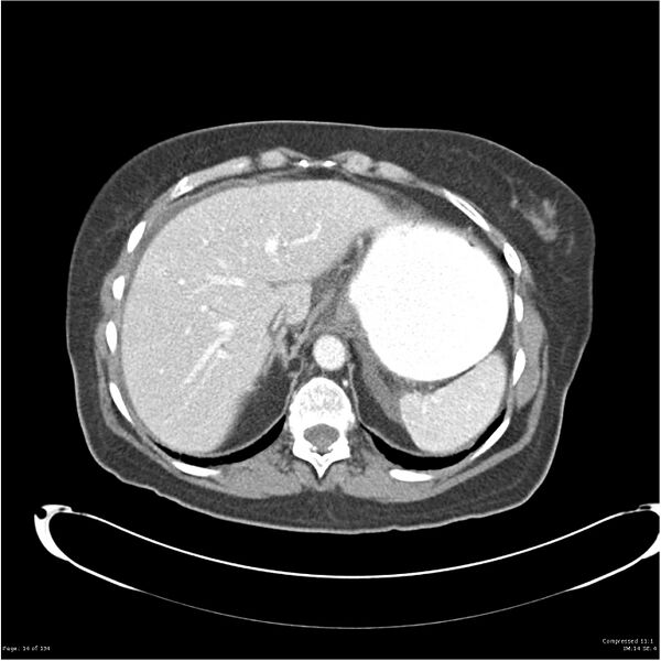 File:Acute pancreatitis (Radiopaedia 19136-19117 Axial C+ portal venous phase 4).jpg