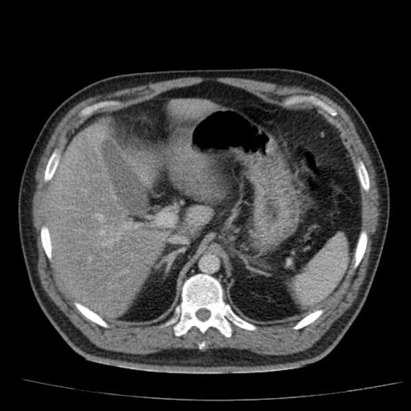 File:Acute pancreatitis (Radiopaedia 26663-26813 Axial C+ portal venous phase 21).jpg