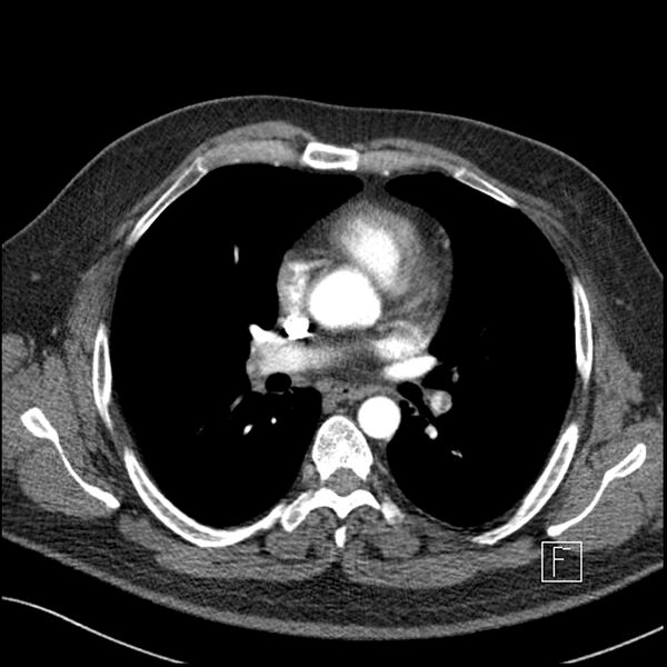 File:Acute pulmonary embolism with pulmonary infarct (Radiopaedia 73062-83768 Axial C+ CTPA 37).jpg