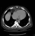 Acute renal failure post IV contrast injection- CT findings (Radiopaedia 47815-52559 Axial C+ portal venous phase 7).jpg