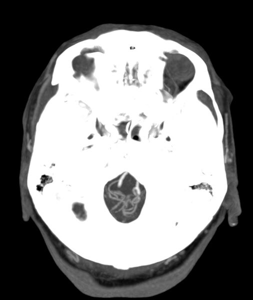 File:Acute right MCA M1 occlusion (Radiopaedia 62268-70454 Axial Phase 2 25).jpg