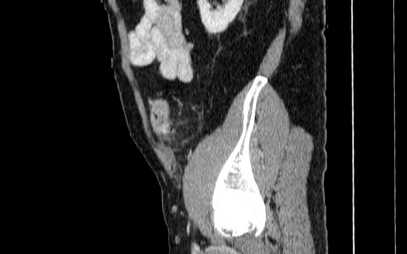 File:Acute sigmoid colon diverticulitis (Radiopaedia 55507-61976 Sagittal C+ portal venous phase 100).jpg