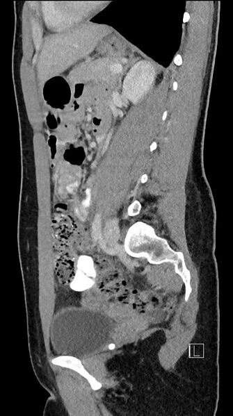 File:Acute uncomplicated appendicitis (Radiopaedia 61374-69304 Sagittal C+ portal venous phase 41).jpg