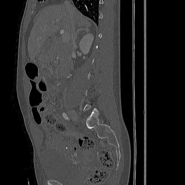 File:Acute vertebral body compression fractures (Radiopaedia 31757-32693 Sagittal bone window 41).jpg