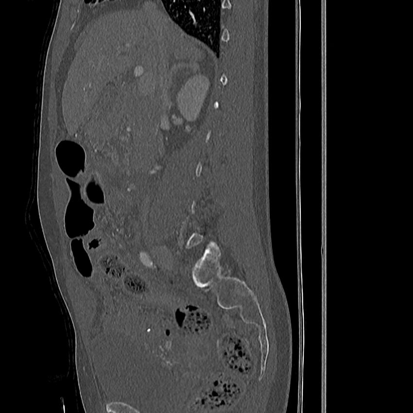 Acute vertebral body compression fractures (Radiopaedia 31757-32693 Sagittal bone window 41).jpg