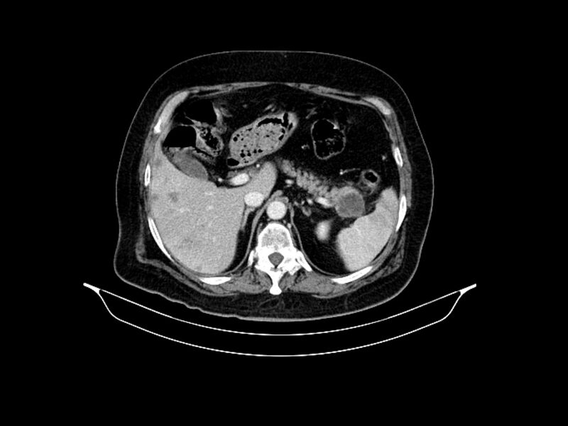 File:Adenocarcinoma of pancreas with hepatic metastasis (Radiopaedia 64332-73122 Axial C+ portal venous phase 30).jpg