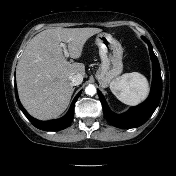 File:Adenocarcinoma of the lung (Radiopaedia 41015-43755 Axial C+ portal venous phase 113).jpg