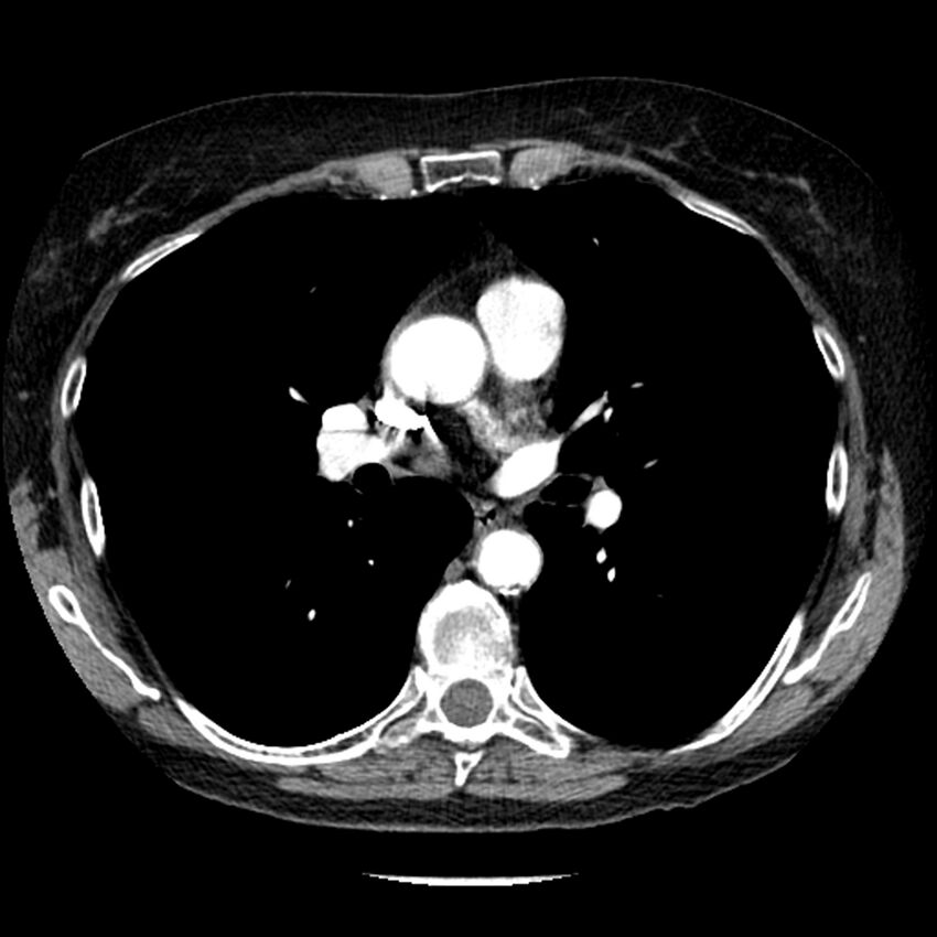 Adenocarcinoma of the lung (Radiopaedia 41015-43755 Axial C+ portal venous phase 59).jpg