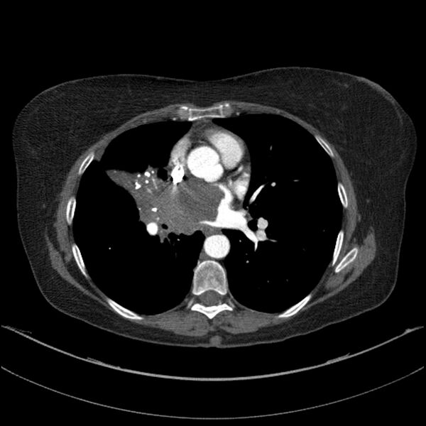 File:Adenocarcinoma of the lung (Radiopaedia 44205-47803 Axial C+ portal venous phase 47).jpg
