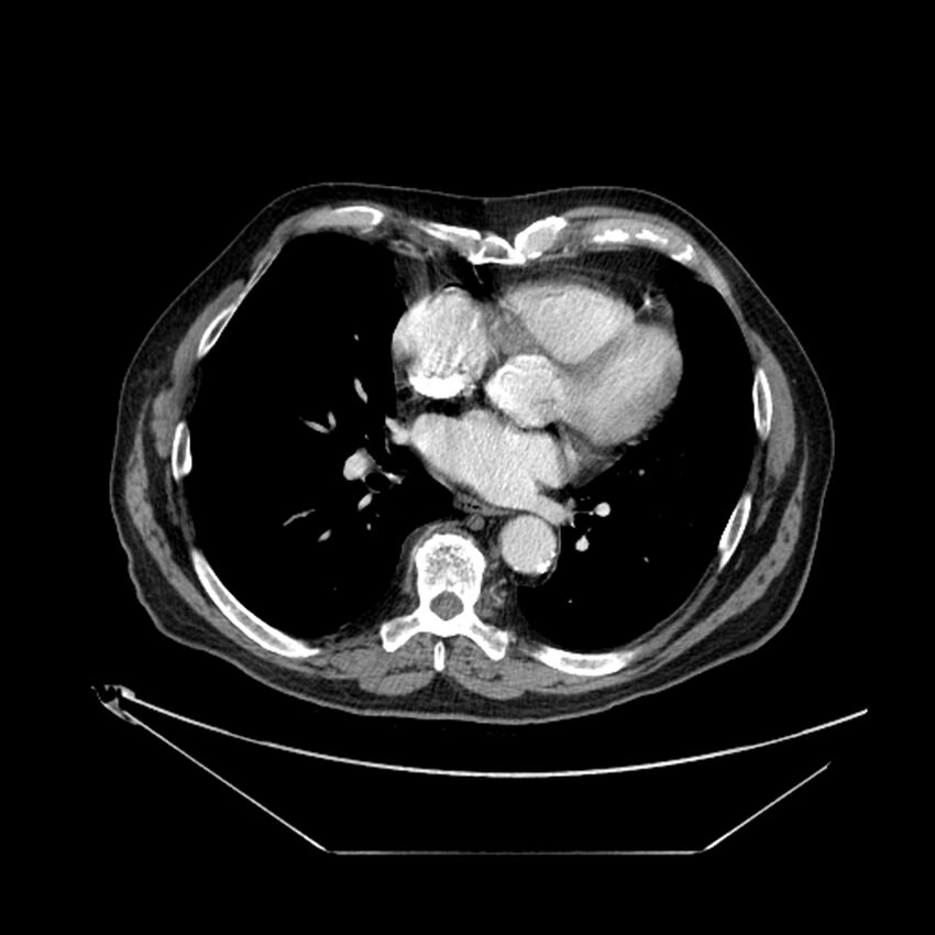 Adenocarcinoma of the lung (Radiopaedia 44876-48759 Axial C+ portal venous phase 50).jpg