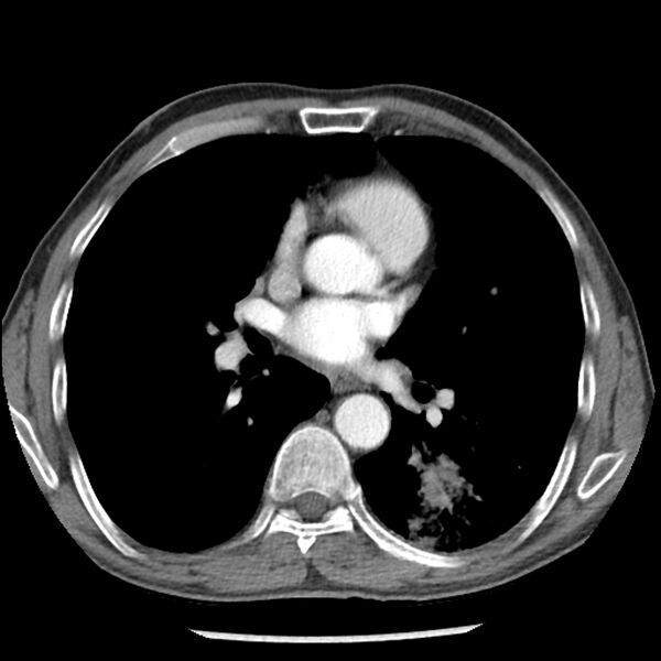 File:Adenocarcinoma of the lung - micropapillary predominant (Radiopaedia 42446-45563 Axial C+ portal venous phase 39).jpg