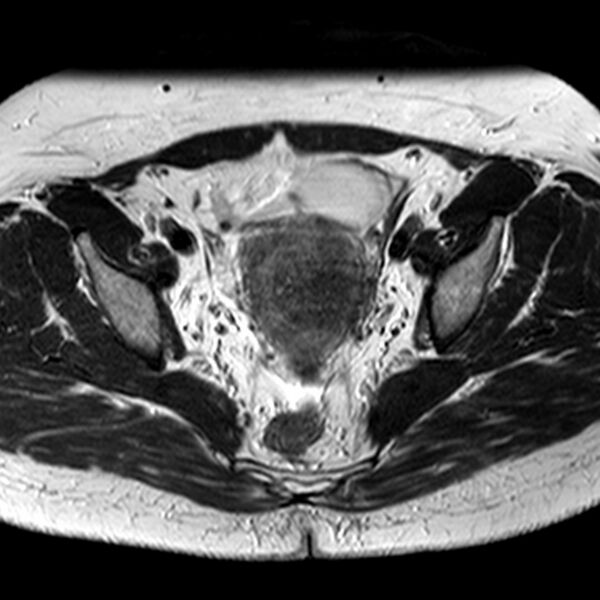 File:Adenomyoma of the uterus (Radiopaedia 9871-10439 Axial T2 17).jpg