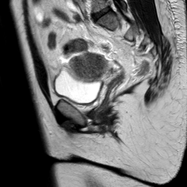 File:Adenomyoma of the uterus (Radiopaedia 9871-10439 Sagittal T2 17).jpg
