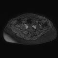 Adenomyoma of the uterus (huge) (Radiopaedia 9870-10438 Axial T1 C+ fat sat 27).jpg