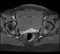 Adenomyosis - ovarian endometriomas (Radiopaedia 67031-76350 Axial T1 C+ fat sat 20).jpg