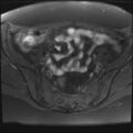 Adenomyosis and endometriotic cysts (Radiopaedia 82300-96367 Axial T1 fat sat 25).jpg