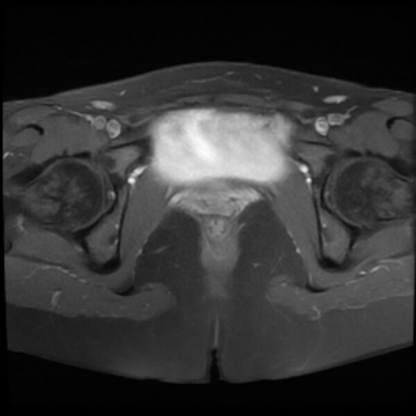 File:Adenomyosis within a septate uterus (Radiopaedia 69963-79981 Axial T1 C+ fat sat 23).jpg
