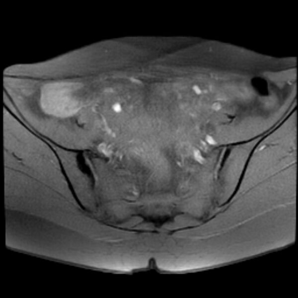 File:Adenomyosis within a septate uterus (Radiopaedia 69963-79981 Axial T1 fat sat 10).jpg