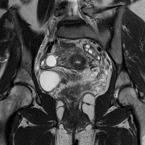 File:Adenomyosis within a septate uterus (Radiopaedia 69963-79981 Coronal T2 18).jpg