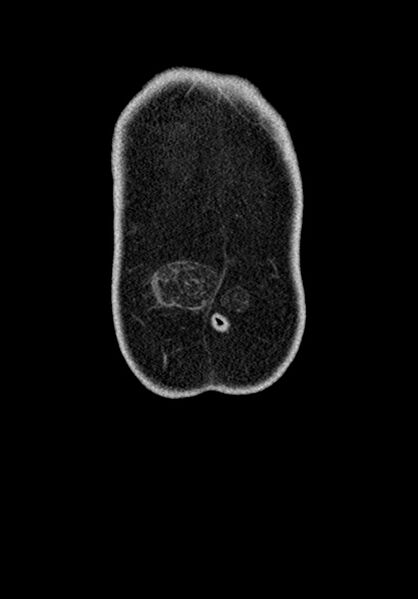 File:Adhesional small bowel obstruction (Radiopaedia 58900-66131 Coronal C+ portal venous phase 48).jpg